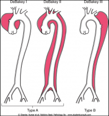 *Deals with which part of aorta is involved (ascending, descending, or both).