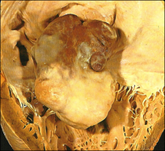 *myxoma in the atria.
*Note how it's pushing down on the mitral valve.