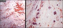 L: Myxoma. Hemorrhagic, acid mucopolysaccharide ground substance, with myxoma cells.

R: Myxoma cells are stellate or globular. It is controversial as to whether these cells are neoplastic.