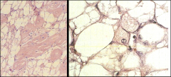 *Lipomatous Hypertrophy of Atrial Septum.
L: Adipose tissue separating myofibers.
R: Fat cells, including those with vacuoles, and two cells resembling brown fat (fetal fat).