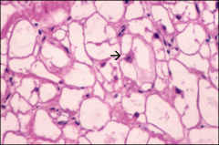Rhabdomyoma. Large, rounded polygonal cells with strands of cytoplasm interspersed among glycogen-rich vacuoles – “spider cells” (arrow).