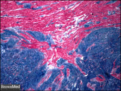Trichrome stain shows myocardium (red) interdigitating with a fibroma (blue). Elastic tissue may be prominent. Except for location, cardiac fibromas are similar to those elsewhere. Though rare, fibromas are the second most common primary cardiac t...