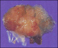 Papillary Fibroelastoma