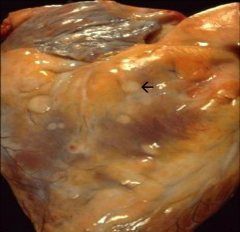 *Metastatic lesions to the epicardial surface of the heart.