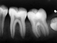 Blunt apices, 
hypoplastic enamel, 
Delayed eruption of teeth