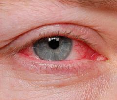 What is wrong with this eye? This disorder is usually caused by which microbial agent?