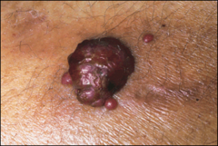 *Bacillary Angiomatosis 
*Cherry hemangioma-like papules and larger lesion resembling a pyogenic granuloma. Patient has advanced HIV disease.