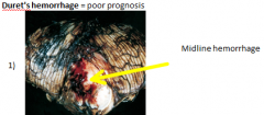 hemorrhage of the pons (midline)

				2) ALWAYS secondary hemorrhages
				3) When brainstem pushed down arteries at 90 rupture causing this
				4) → death