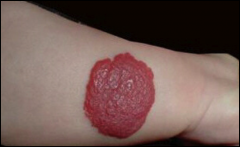 *Most common type of CAPILLARY HEMANGIOMA; strawberry type in newborns.
*Bright red to blue, flat or slightly elevated, covered by intact epidermis.
*Occasionally pedunculated.
