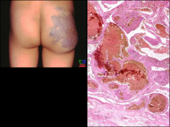 *Cavernous Hemangioma.
*Large, dilated channels. 
*No capsule but margins sharply defined.