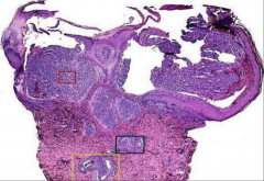 Lobular hemangioma (pyogenic granuloma), low power view.