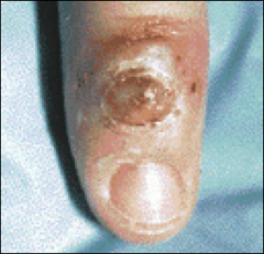 *HIV positive male, cutaneous lesion.
*Could be Kaposi, but biopsy needed to differentiate from bacillary angiomatosis, or pyogenic granuloma, or other bacterial or fungal infections.