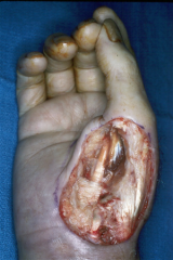 Hx:67yo M has soft tissue defect on the palmar aspect of his R hand following a resection of mass  Fig A &B. Which is most appropriate for achieving coverage of the defect? 1-Vacuum-assisted wound closure only; 2-Flap coverage with full-thickness ...