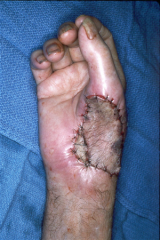 Soft tissue defects of the palm are most appropriately treated with flap w/ full-thickness grafts. A flap is tissue supported by blood vessels and moved from a donor site to a recipient site to cover a defect in tissue. full-thickness coverage was...