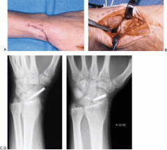 An open dorsal approach for antegrade screw fixation of a nondisplaced scaphoid waist fx differs in which of the following ways compared to a percutaneous dorsal approach? 1-Decreased risk of proximal pole AVN; 2-Increased risk of PIN injury 
3-D...