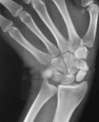 Hx:20yo skateboarder fell 6 mths ago and has had radial-sided wrist pain since. His xray upon presentation in fig A. What is the tx at this time?  1-  short arm thumb spica cast; 2-long arm thumb spica cast; 3-wrist arthroscopy to evaluate interca...