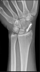 pt has a scaphoid waist fx nonunion. scaphoid nonunions left untreated have a determined course of collapse and progressive arthritis (scaphoid nonunion advanced collapse - SNAC). the standard tx of scaphoid nonunions is ORIF w/ BG; non-op Tx is n...