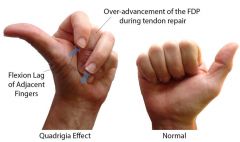 Hx:35yo butcher inadvertently lacerates his ring finger FDP tendon at the level of the DIP joint which is subsequently repaired. Following the operation he notes the inability to fully flex his long and small fingers at the DIP joints with attempt...