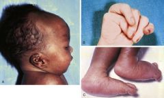 Rocker bottom feet, hand clenching-chromosomal abnormality?