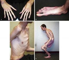 AD, 25% due to new mutation
-Skeletal changes (tall/thin, scoliosis, pectus deformities, long fingers)
-Eyes (myopia, dislocated lens**)
-Heart (aortic dilation**, dissections)
-Not common-learning disorders

If no family hx-major criteria i...