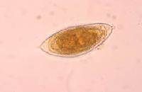 what will you see on labs of urinary schistosomiasis?