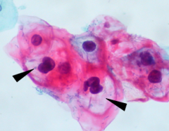 Virus del Papiloma humano.