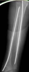 - Restoration of radial bow is similar in both groups
- midshaft pediatric both bone forearm fractures with minimal comminution in transverse and oblique patterns and acutely after injury prior to the presentation of fracture callus
-Refracture
...