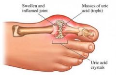 NOTE: the 3 most common places for gout are:
i. 1st MTP (most common)
ii. ankle
iii. knee