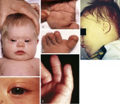CHD, duodenal atresia, leukemia, Hirschprung's disease, MR. Hypotonia is one of the most common abnormalities in babies who have DS, occurring in up to 90%.