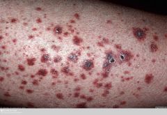Immune complex in post-capillary vessels
Palpable purpura most commonly on legs - may be mm-2cm +/-blisters/pustules
Aetiology: Hep A-C, strep, mycobacterium; BB, penicillin, thiazide diuretics; CLL, lymphoma, myeloma; small vessel vasculitides...