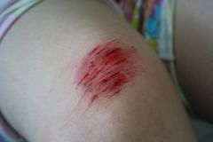 خراش برداشتن


Sharon tripped and fell down and grazed her knee


 


her knee has been grazed