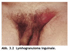 - unilaterale, inguinale, schmerzhafte Lymphadenopathie (sog. Bubo) ggf. Ruptur und Fistelung