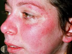 Rarer than discoid.
Photosensitive butterfly rash on face


Appears after ~2 days


Affects epidermis and high dermis - no scarring
   