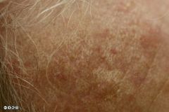 Chronic UV exposure can result in alteration sin collagen causing fragmentation of fibres and apparent increase in volume - yellow appearnce. 