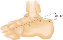 A = Posterior tuberosity


B = Apex of posterior facet


C = Apex of anterior process