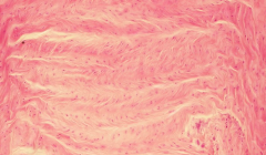 - Annulus fibrosis of intervertebral disc (fibrocartilage)
- Parallel rows of chondrocytes are arranged between layers of collagen bundles
- Gives it a herringbone appearance