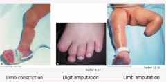 amniotic bands
limb constriction
digit/limb amputation


not enough fluid, too constricting= club foot


arthrogryposis: congenital joint contractions