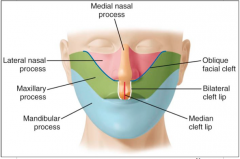 Bilateral cleft lip


Median cleft lip