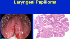 Papilloma refers to a benign epithelial tumor with finger-like proliferations