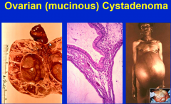 cystic neoplasm forming glands.
