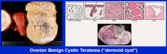 neoplastic cells from more than one germ cell layer arising from multipotent cells (frequently gonads).

Wikipedia: A teratoma is an encapsulated tumor with tissue or organ components resembling normal derivatives of all three germ layers.