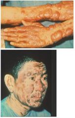 post kala-azar dermal lesihmanoid,


badly disfigured face


DEATH (if untreated, w/i 2-3 yrs)