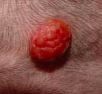 this "raspberry" appearance is typical of what type of neoplasm?
what is the prognosis?