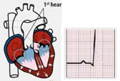 When 1/2 the ventricle depolarizes, what is occuring?