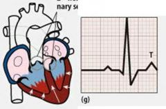 After the ventricle has depolarized & reached 0, what occurs when the T wave becomes (+)?