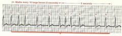 (no P wave = Irregular rhythm)


 


count out 30 large boxes (6 seconds). take the # of R waves in 30 boxes * 10 = R waves /60 sec (bpm)