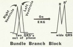 bundle branch block


(whichever side blocked will have delayed firing)