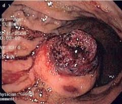 a/w ALL, GI adenocarcinoma


 


looks like a carcinoma blooming in the colon