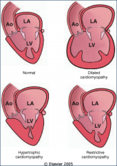 *Dilated cardiomyopathy (90%):
-LV chamber enlargement / minimal hypertrophy.
-Impaired systolic contraction.

*Hypertrophic cardiomyopathy:
-LV thickening.
-Abnormal diastolic relaxation.

*Restrictive cardiomyopathy:
-Stiffened myocardi...