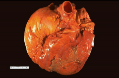 Gross appearance of heart in dilated cardiomyopathy.